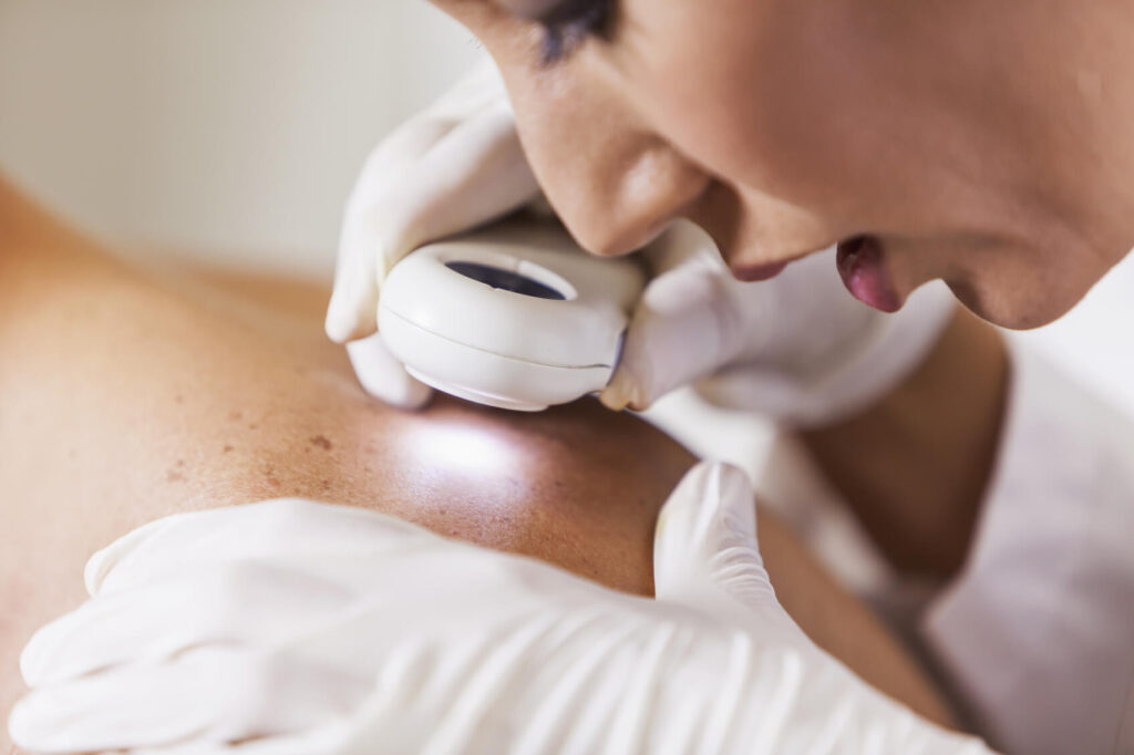 Controlli dermatologici specializzati e mappatura dei nei: prevenzione e rischio melanoma
