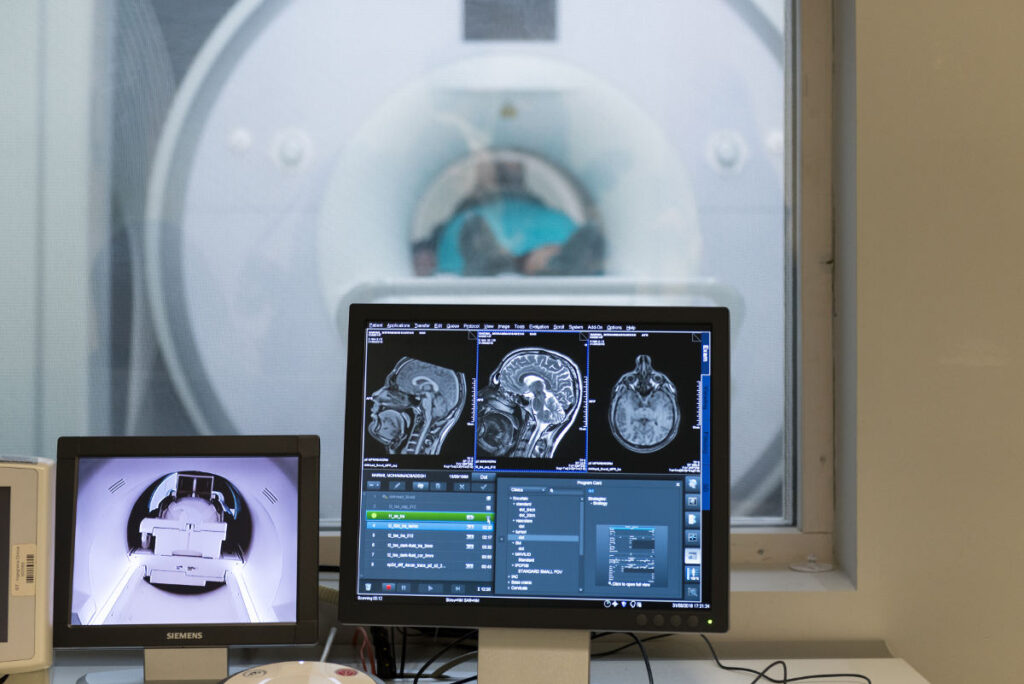 La risonanza magnetica come strumento fondamentale nel monitoraggio della sclerosi multipla