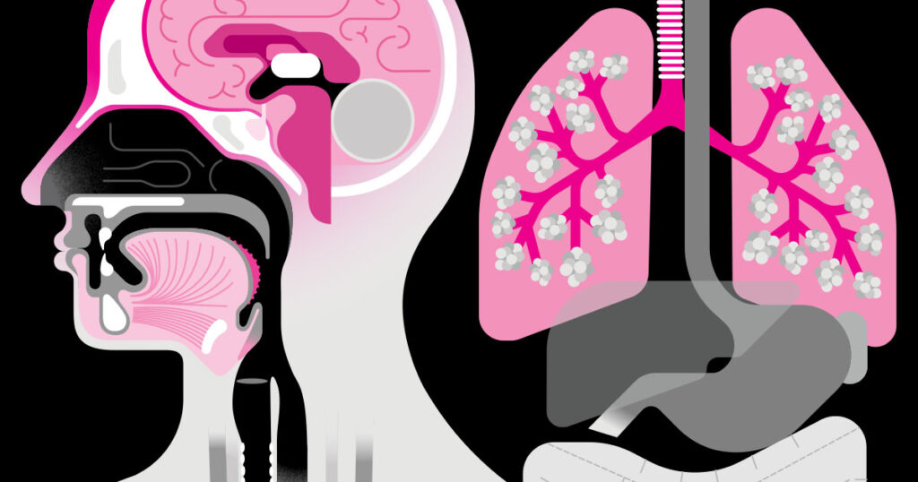 Quattro sottotipi di Long Covid