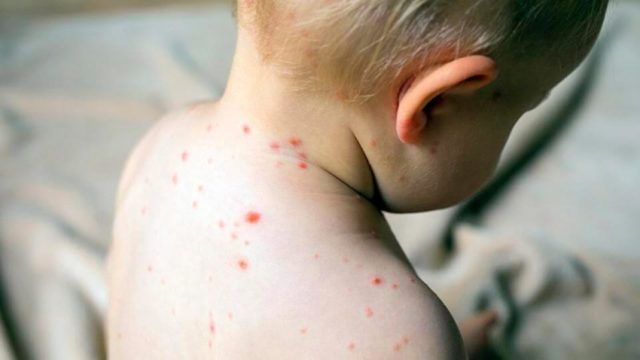 Modalità di trasmissione e focolai di morbillo