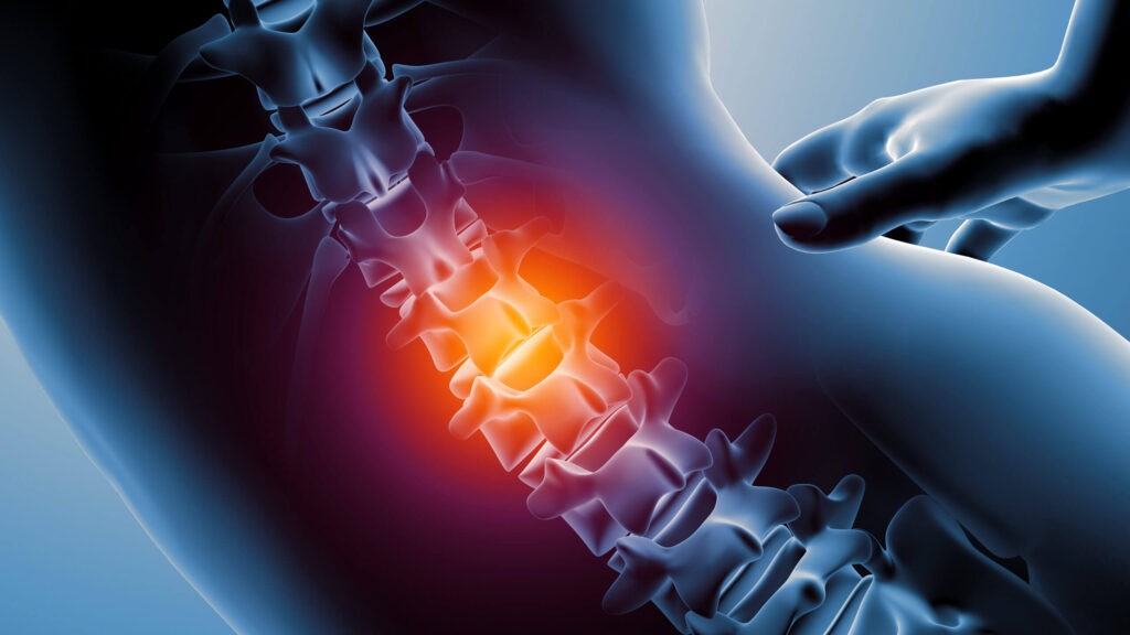 Patologie degenerative della colonna vertebrale: un impatto crescente sulla salute pubblica