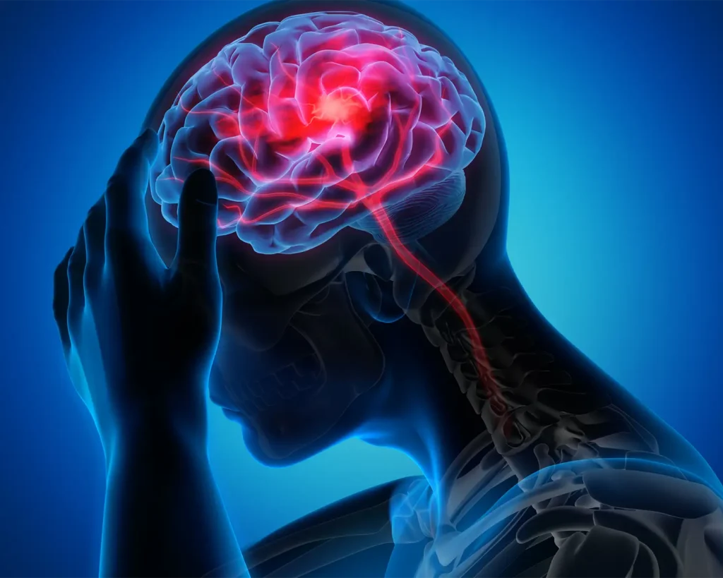 La gestione a lungo termine del paziente post ictus ischemico