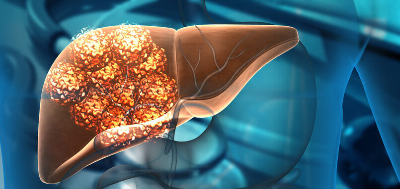 Visite specialistiche mirate e diagnosi precoce del tumore al pancreas, tra i numeri uno per mortalità