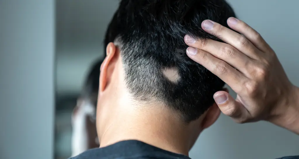 Per anni poche risposte: ora una cura possibile per i casi severi di alopecia areata