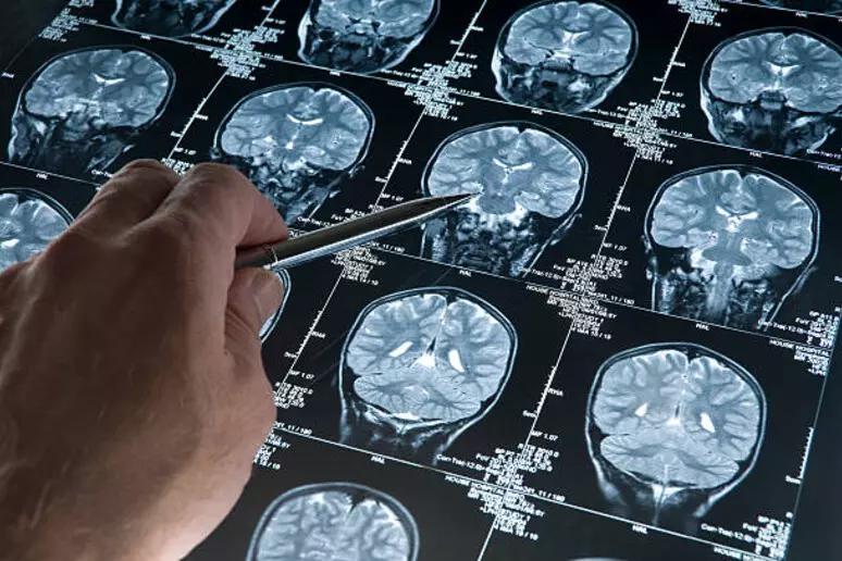 Visite specialistiche neurologiche e prevenzione contro il glioblastoma