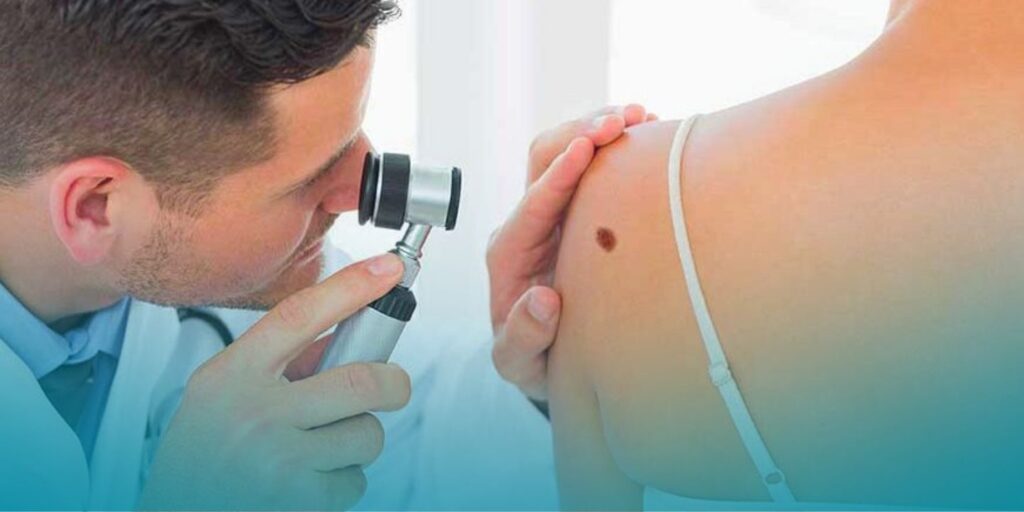 Visite specialistiche e prevenzione: la mappatura dei nei e la battaglia contro il nemico melanoma