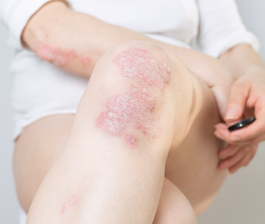 Psoriasi e qualità della vita