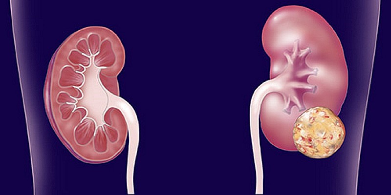 Visite specialistiche e prevenzione: la cura del rene