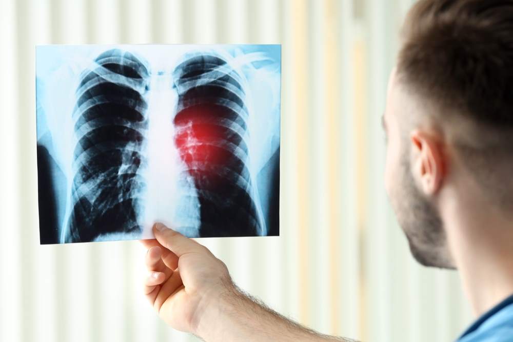 Visite specialistiche e prevenzione del tumore al polmone: il primo passo fondamentale è rivolgersi allo pneumologo